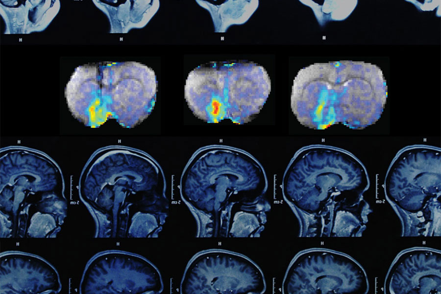 A series of three MRI images shows how dopamine concentrations change over time in the brain.