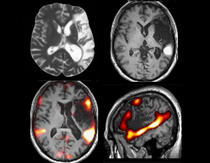 Four brain scans with the bottom two scans showing activation areas in red.